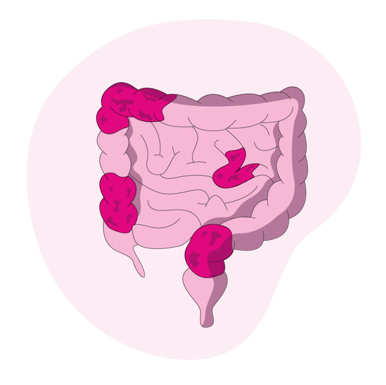 Comprendre le syndrome de l’intestin irritable Info.avec.fr