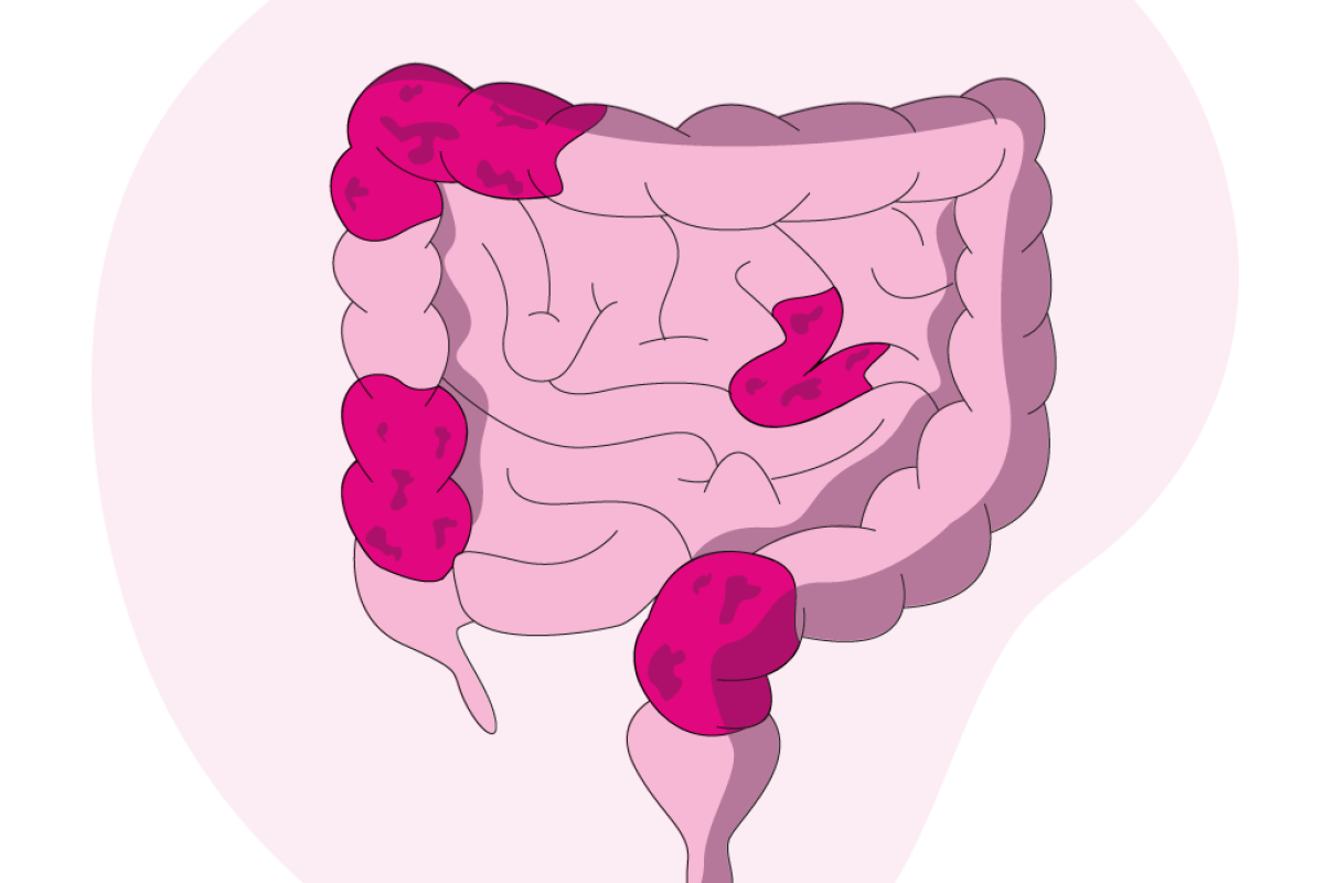 syndrome intestin irritable